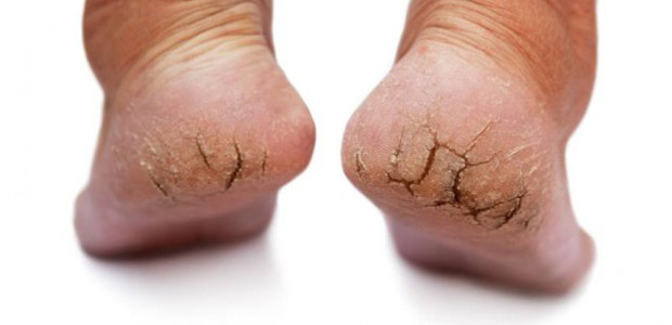 pés rachados sem tratamento foot works avon serum concentrado